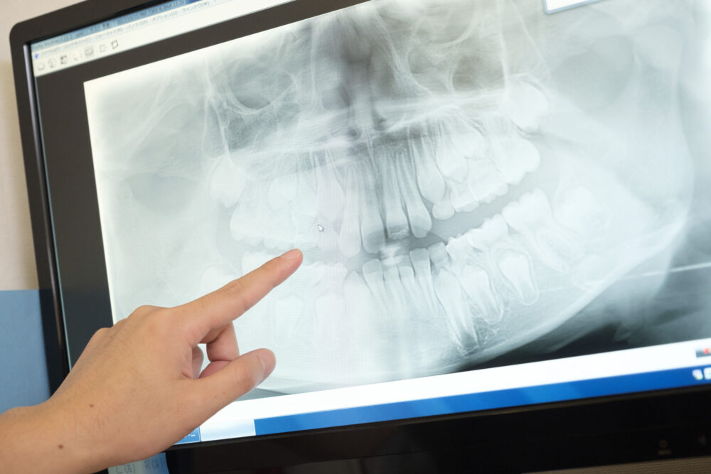 立体的に根管を診断する歯科用CT