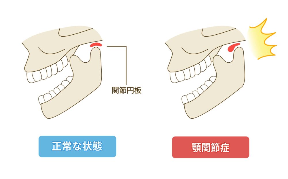 顎関節症