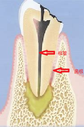 精密な根管治療のご紹介